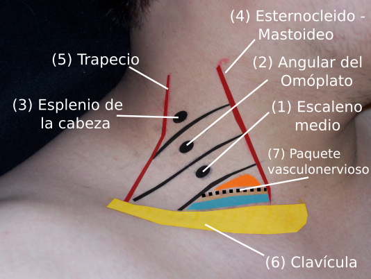 Figura no. 1 Marcación de los puntos de referencia y los músculos de la cara lateral del cuello, para la aplicación de toxina botulínica en la posición de flexión lateral de cuello (laterocolis).
