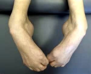 Fig 2. Espasticidad de músculos sóleo, gemelos, tibiales Posteriores y flexores de dedos.